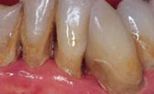 Гигиена полости рта. Метод первичной профилактики стоматологических заболеваний